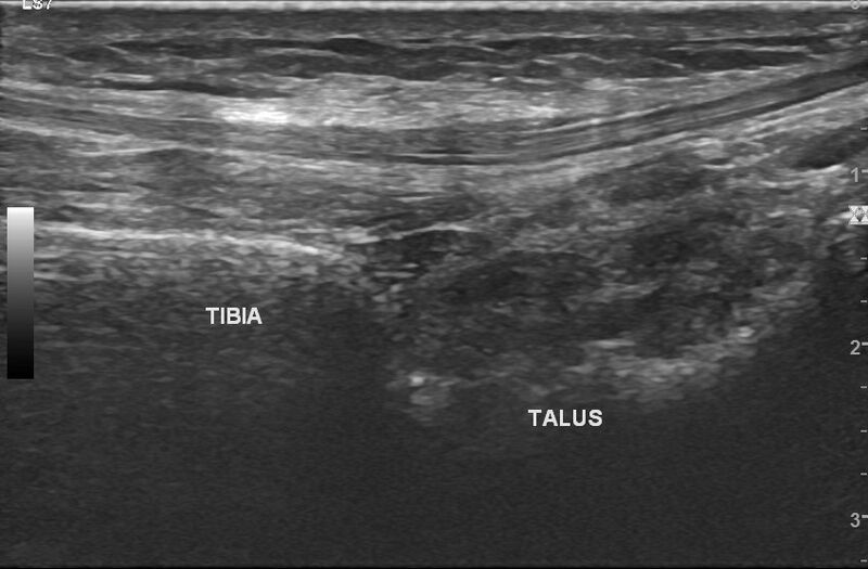 File:Anterior inferior tibiofibular ligament injury (Radiopaedia 86246).jpg