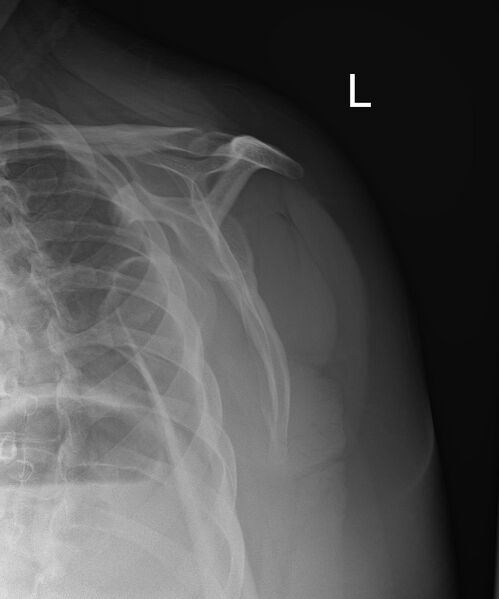 File:Anterior shoulder dislocation (Radiopaedia 55849-62434 Oblique 1).jpg