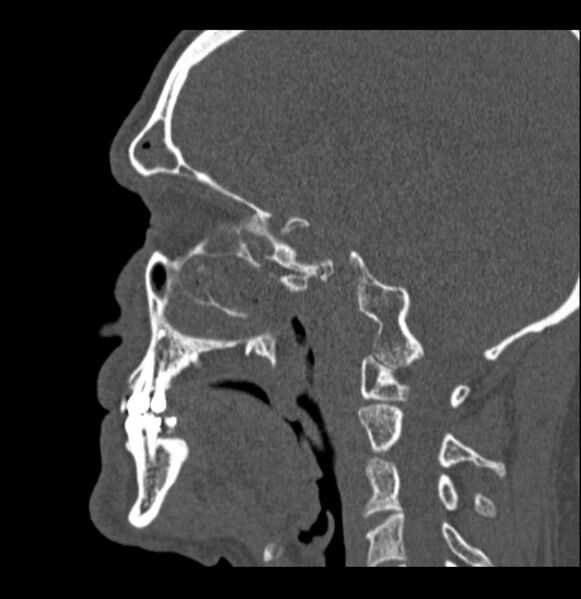 File:Antrochoanal polyp (Radiopaedia 79011-92169 Sagittal bone window 15).jpg
