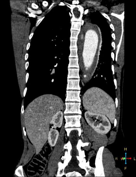 File:Aortic aneurysm and penetrating ulcer (Radiopaedia 23590-23704 B 20).jpg