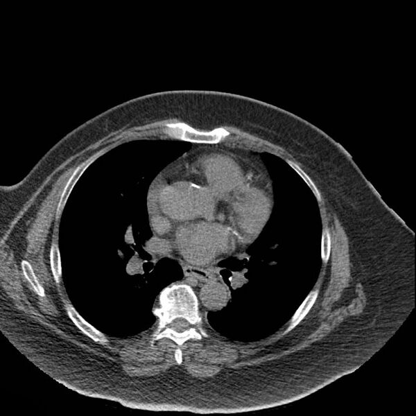 File:Aortic arch false aneurysm (Radiopaedia 14667-14587 Axial non-contrast 26).jpg