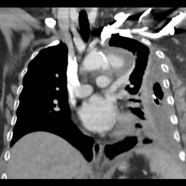 File:Aortic arch false aneurysm (Radiopaedia 14667-14588 B 6).jpg