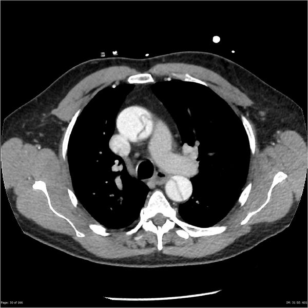 File:Aortic dissection- Stanford A (Radiopaedia 37759-39664 A 21).jpg
