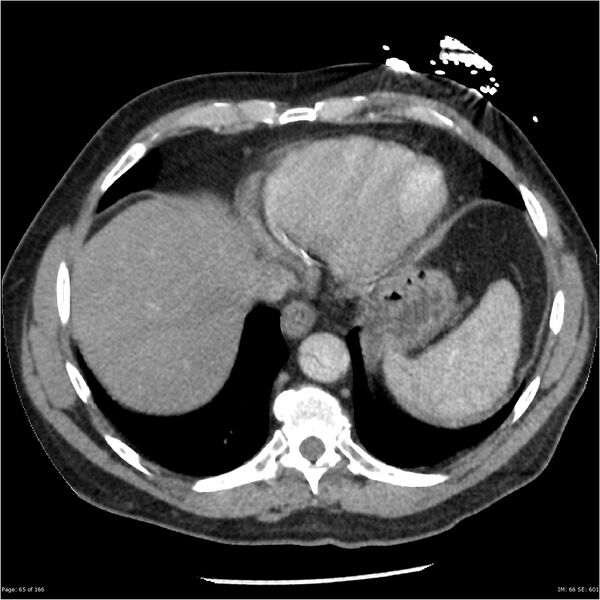 File:Aortic dissection. Stanford A (Radiopaedia 37759-39664 Axial 56).jpg