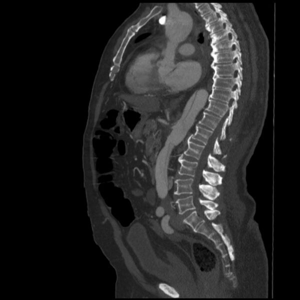 File:Aortic dissection (Radiopaedia 28802-29105 C 22).jpg