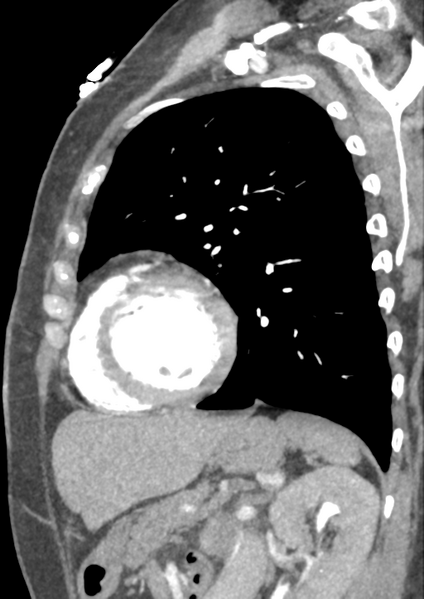 File:Aortic dissection - Stanford type B (Radiopaedia 50171-55512 C 10).png