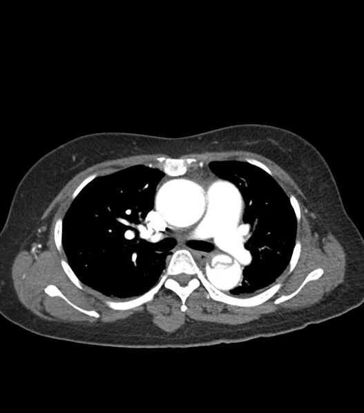 File:Aortic dissection with renal ischemia (Radiopaedia 76573-88338 A 24).jpg