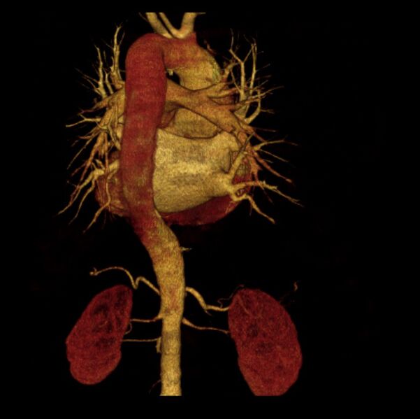 File:Aortic dissection with rupture into pericardium (Radiopaedia 12384-12647 D 19).jpg