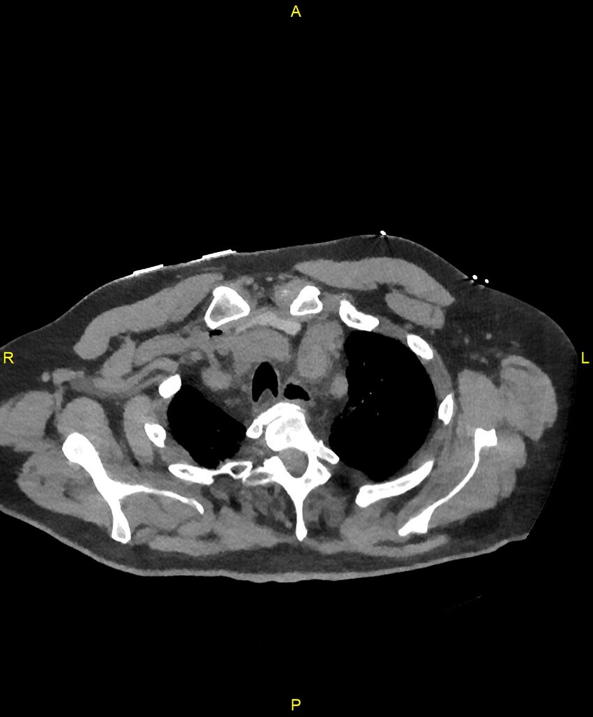 Aortic rupture (Radiopaedia 88822-105594 Axial non-contrast 26).jpg