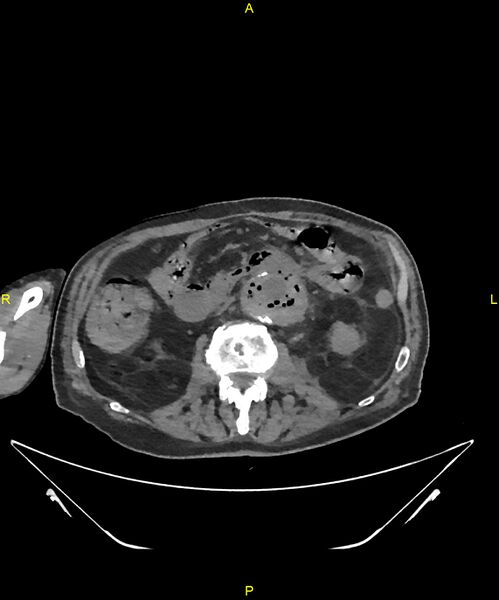 File:Aortoenteric fistula (Radiopaedia 84308-99603 Axial non-contrast 165).jpg