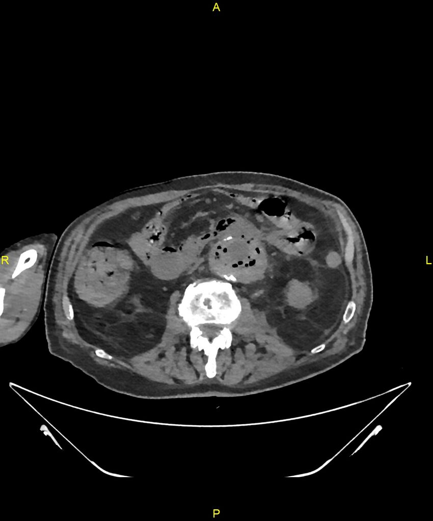 Aortoenteric fistula (Radiopaedia 84308-99603 Axial non-contrast 165).jpg