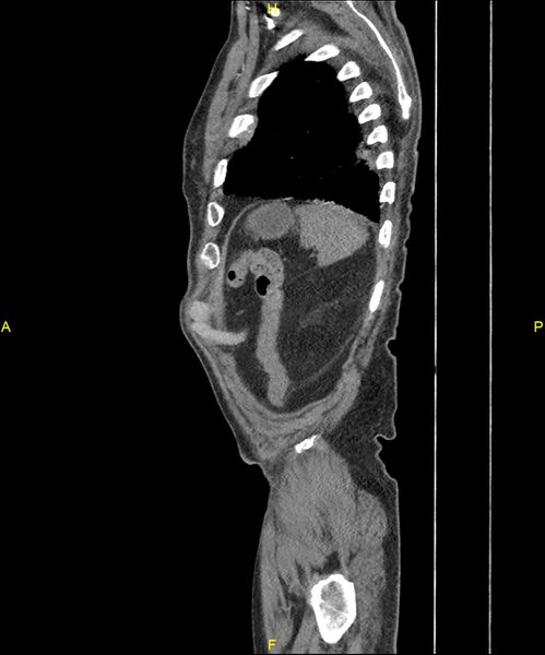 File:Aortoenteric fistula (Radiopaedia 84308-99603 C 299).jpg