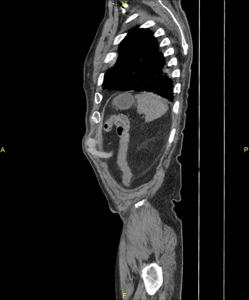 Aortoenteric fistula (Radiopaedia 84308-99603 C 299).jpg