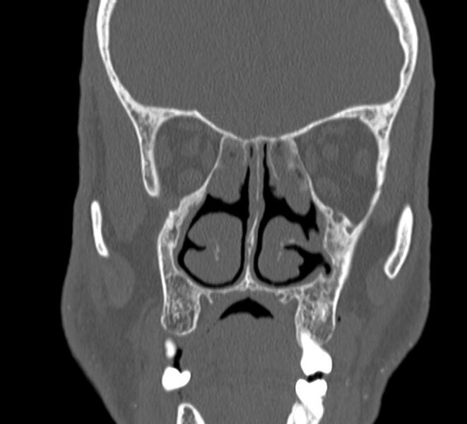File:Aplastic maxillary sinuses (Radiopaedia 60030-67561 Coronal non-contrast 20).jpg