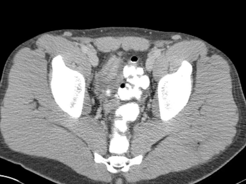 Appendicitis and incidental foregut duplication cyst (Radiopaedia 52962-58916 A 91).jpg