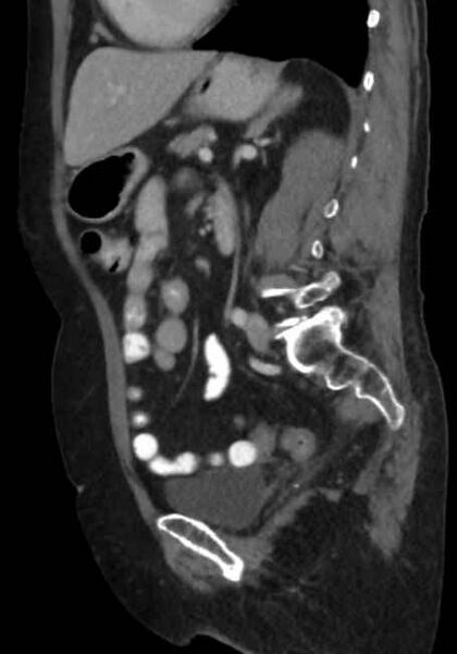 File:Appendicitis due to chicken fibula (Radiopaedia 74314-85198 C 60).jpg