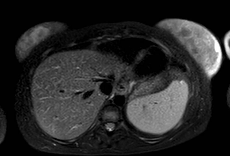 File:Appendicitis in gravida (MRI) (Radiopaedia 89433-106395 Axial T2 SPAIR 9).jpg