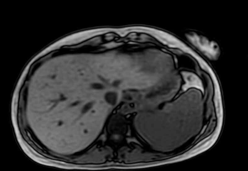 File:Appendicitis in gravida (MRI) (Radiopaedia 89433-106395 D 5).jpg