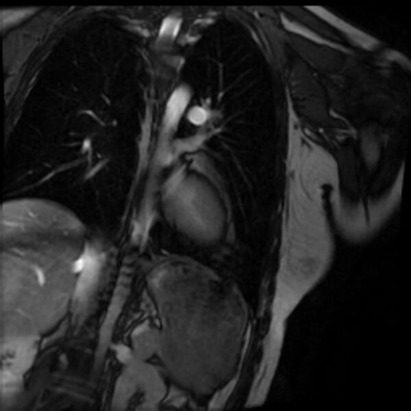 File:Arrhythmogenic right ventricular cardiomyopathy (Radiopaedia 87505-103850 2ch (LV) Cine SSFP 65).jpg