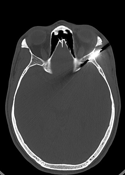 File:Arrow injury to the head (Radiopaedia 75266-86388 Axial bone window 68).jpg