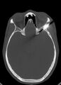 Arrow injury to the head (Radiopaedia 75266-86388 Axial bone window 68).jpg