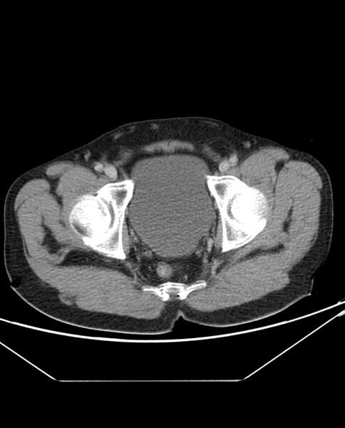 File:Arterial occlusive mesenteric ischemia (Radiopaedia 84641-100054 A 112).jpg