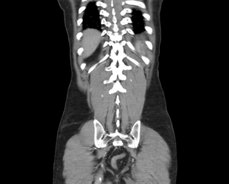 File:Arterial occlusive mesenteric ischemia (Radiopaedia 84641-100060 B 48).jpg