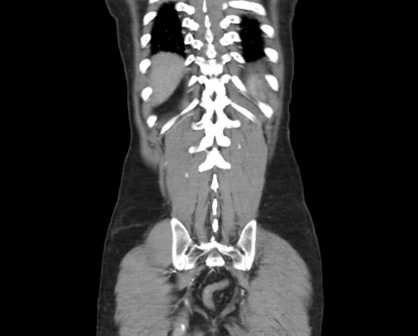 Arterial occlusive mesenteric ischemia (Radiopaedia 84641-100060 B 48).jpg