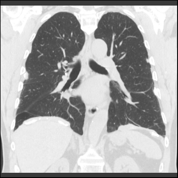 File:Asbestos-related pleural plaques (Radiopaedia 39069-41255 Coronal lung window 37).jpg