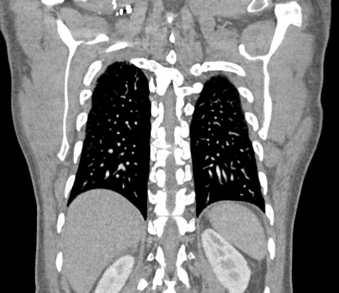 File:Ascending aortic aneurysm (Radiopaedia 86279-102297 B 54).jpg