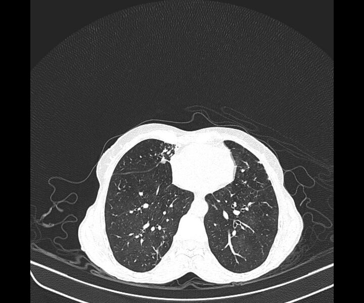 File:Aspergillomas (Radiopaedia 66779-76110 Axial lung window 31).jpg