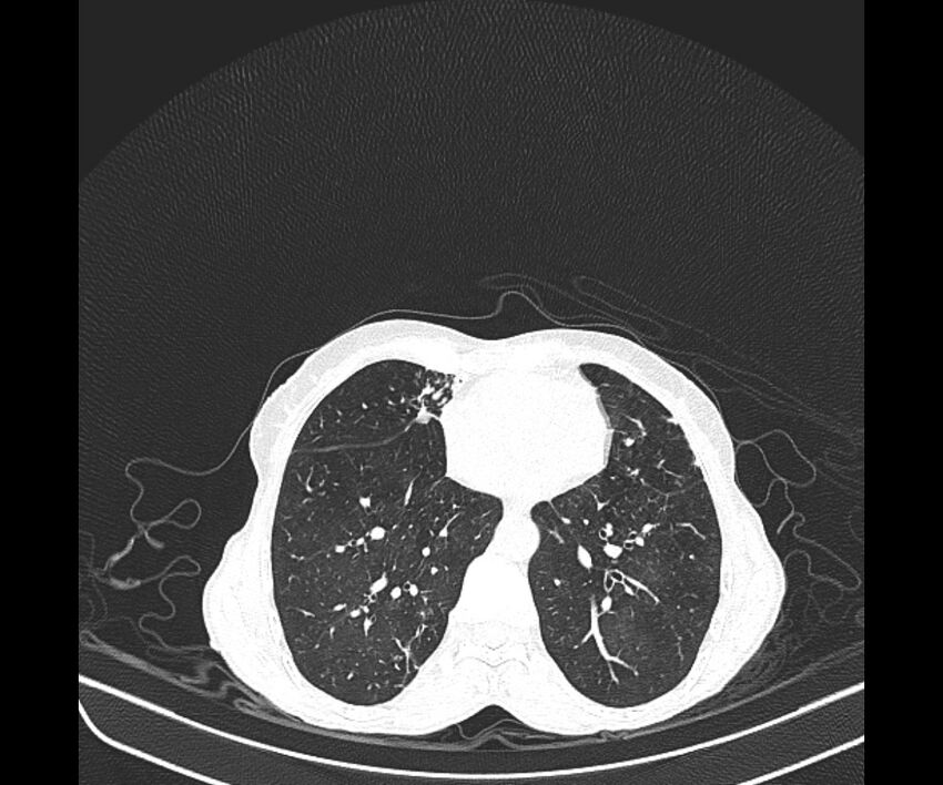 Aspergillomas (Radiopaedia 66779-76110 Axial lung window 31).jpg