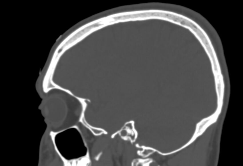 Asymptomatic occipital spur (Radiopaedia 87753-104201 Sagittal bone window 217).jpg