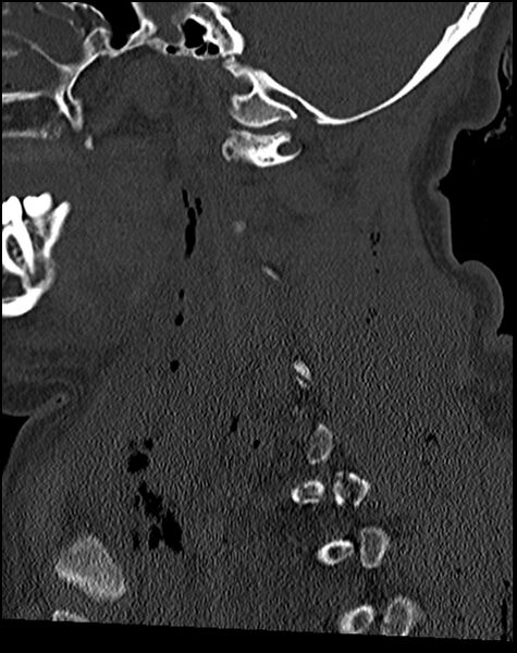 File:Atlanto-occipital dissociation - Traynelis type 1 (Radiopaedia 87570-103948 Sagittal bone window 34).jpg