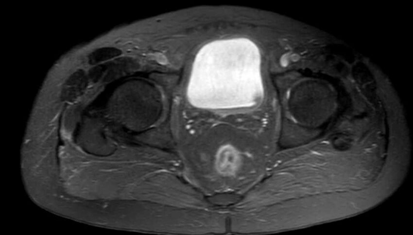 Atypical lipomatous tumor - thigh (Radiopaedia 68975-78734 Axial PD fat sat 94).jpg