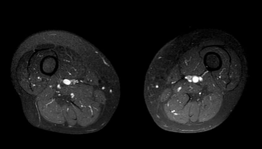 Atypical lipomatous tumor - thigh (Radiopaedia 68975-78734 Axial T1 C+ fat sat 40).jpg