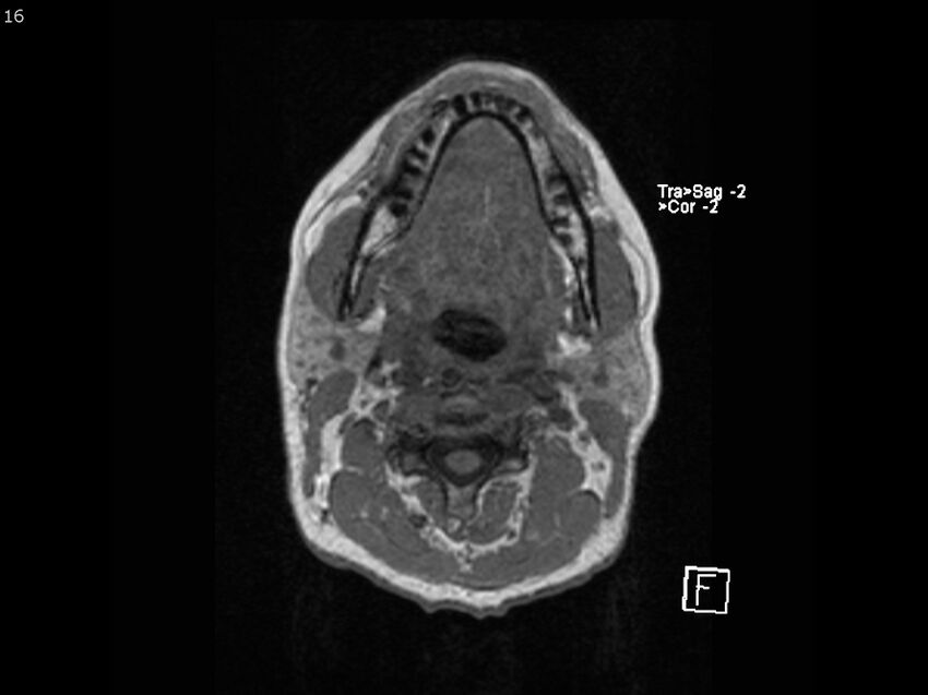 Atypical meningioma - intraosseous (Radiopaedia 64915-74572 Axial T1 16).jpg