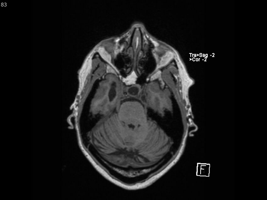 Atypical meningioma - intraosseous (Radiopaedia 64915-74572 Axial T1 83).jpg