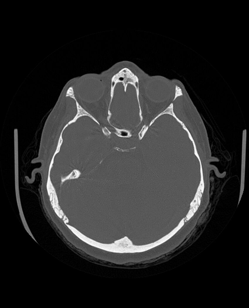 Automastoidectomy with labyrinthine fistula (Radiopaedia 84143-99411 Axial non-contrast 105).jpg