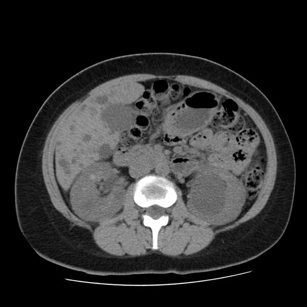 File:Autosomal dominant polycystic kidney disease (Radiopaedia 23061-23093 Axial non-contrast 28).jpg