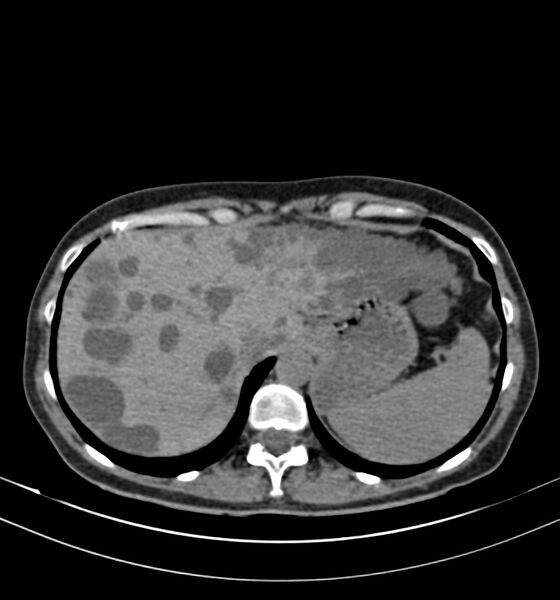 File:Autosomal dominant polycystic kidney disease (Radiopaedia 41918-44922 Axial non-contrast 3).jpg