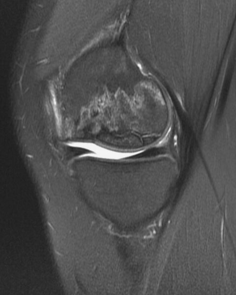 File:Avascular necrosis of the knee (Radiopaedia 2583-6277 Sagittal STIR 1).jpg