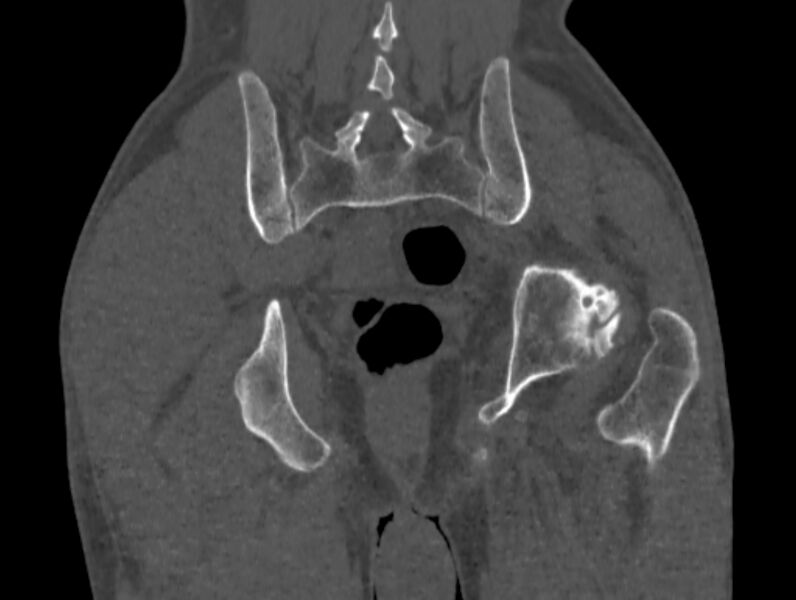 File:Avascular necrosis of the left hip (Radiopaedia 75068-86125 Coronal bone window 77).jpg