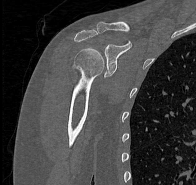File:Avulsion fracture - greater tuberosity of humerus (Radiopaedia 71216-81514 Coronal bone window 30).jpg