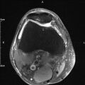 Avulsion fracture of the fibular head (Radiopaedia 74804-85808 Axial PD fat sat 10).jpg