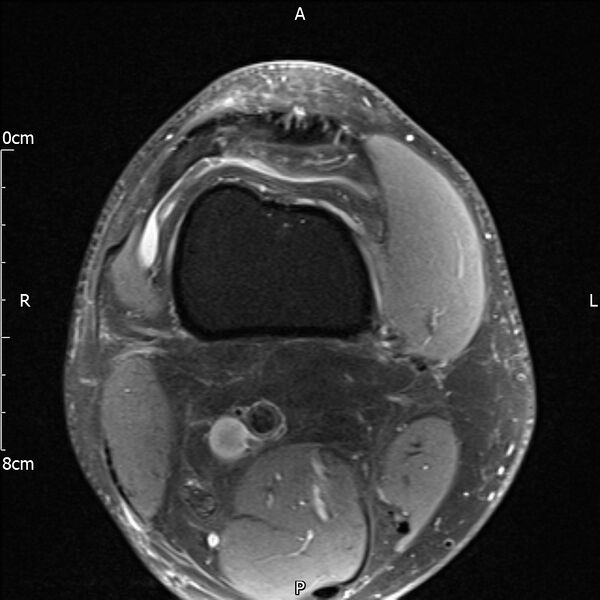 File:Avulsion fracture of the fibular head (Radiopaedia 74804-85808 Axial PD fat sat 3).jpg