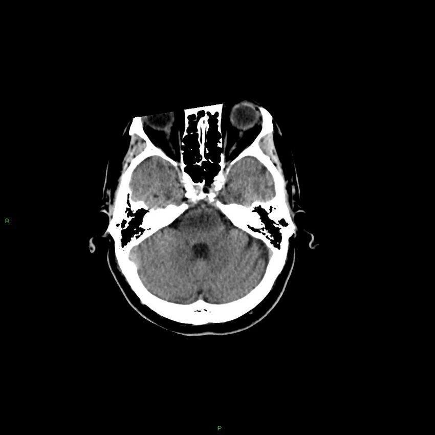 Basal ganglia hemorrhage (Radiopaedia 58346-65467 Axial non-contrast 42).jpg