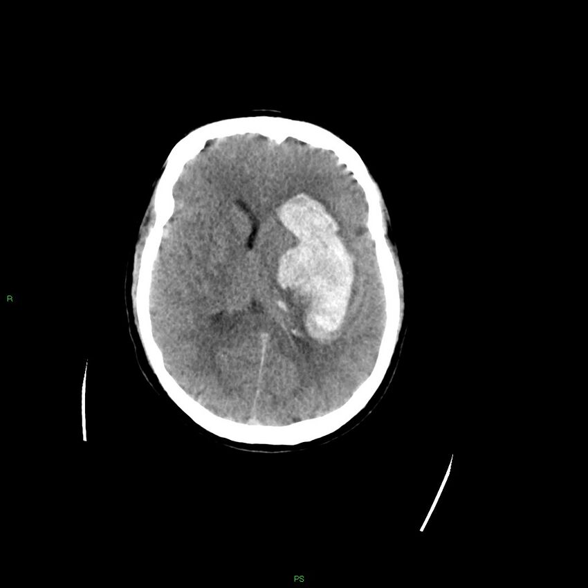 Basal ganglia hemorrhage (Radiopaedia 58349-65472 Axial non-contrast 29).jpg