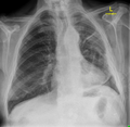 Basal pneumothorax and trapped lung post thoracentesis (Radiopaedia 30898).png