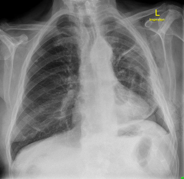 File:Basal pneumothorax and trapped lung post thoracentesis (Radiopaedia 30898).png